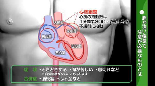 北海道 医pedia 高血圧 血圧と脈拍管理の重要性について考える