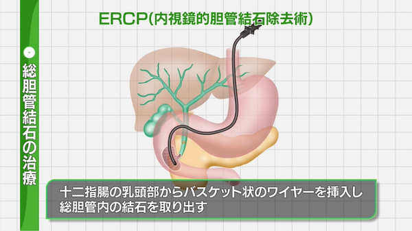 総 胆管 結石