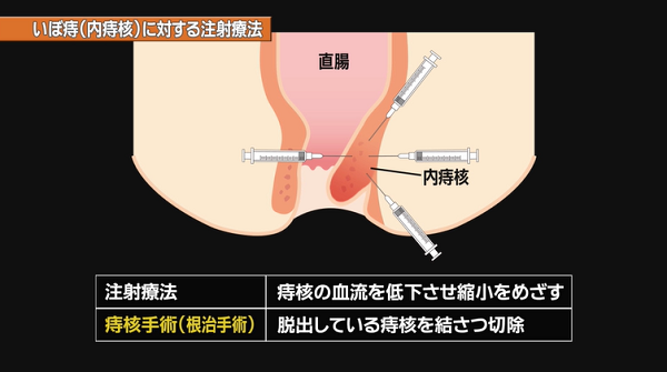 北海道 医pedia 札幌駅前 樽見おしりとおなかのクリニック 痔について考える