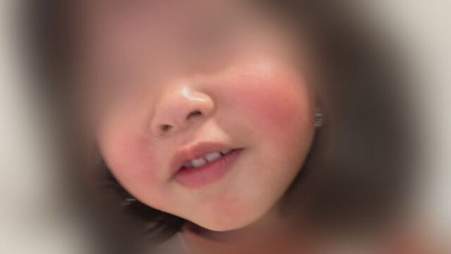 道内、リンゴ病に注意！感染拡大で警報レベル　子どもだけでなく大人も感染の可能性　妊婦は特に注意